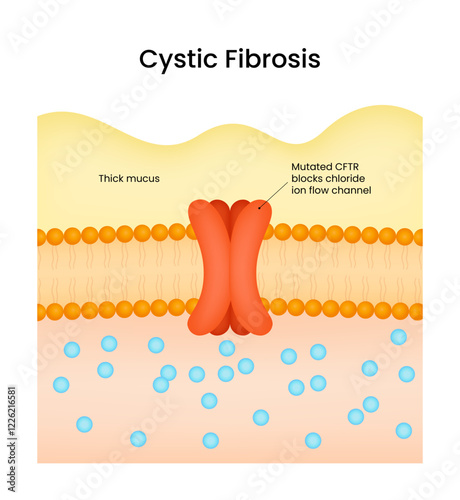 Cystic Fibrosis Symptoms and Causes