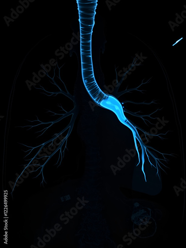 Pulmonary angiography with contrast injected into embolization of right bronchial artery photo