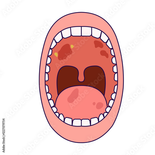 oral cancer disease