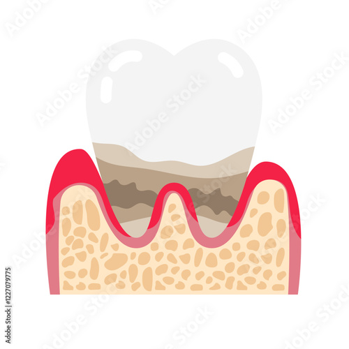 periodontal disease