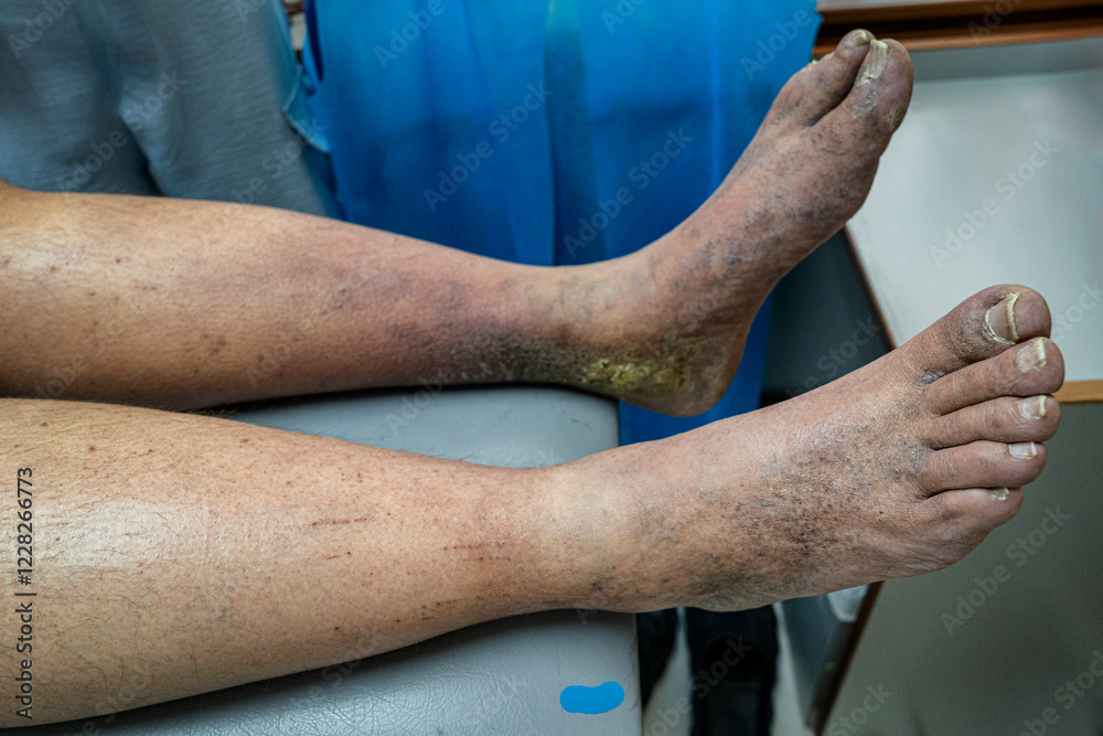 Medical themes: Female patient with venous insufficiency in her legs.