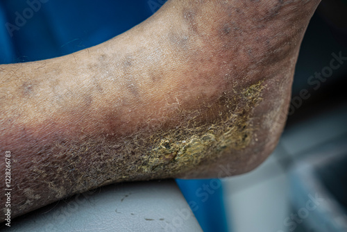 Medical themes: Female patient with venous insufficiency in her foot.