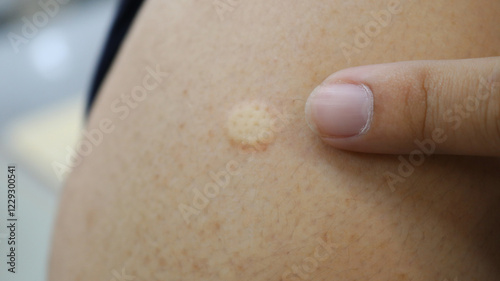 side effect from inject vaccine solution in intradermal. photo