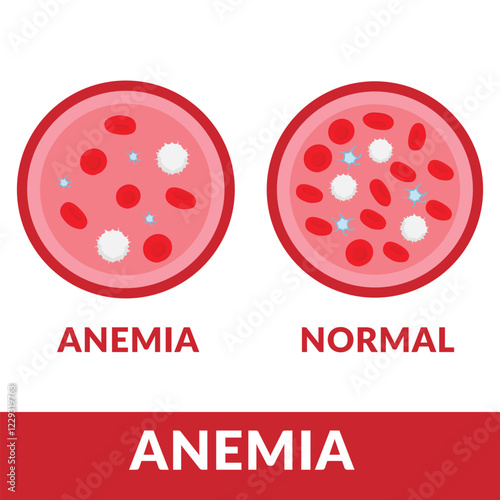 Anemia disease. The difference of Normal red blood cell and Anemia