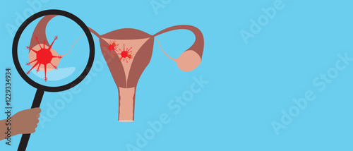 Uterus with malignant tumor as oncology concept, flat vector stock illustration or copy space template with cervical cancer or ovarian cancer