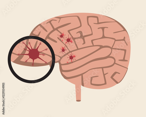 Isolated brain with malignant tumor as oncology concept, flat vector stock illustration as brain cancer