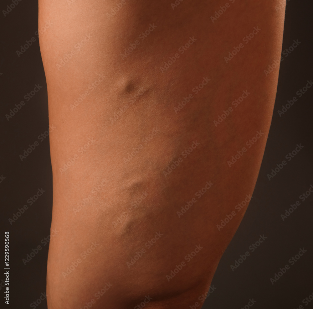 Fototapeta premium Beautiful slender woman shows varicose veins on the legs. Treatment of varicose veins and capillaries.