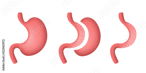 Longitudinal gastrectomy. Gastric resection. Vector 3D illustration.