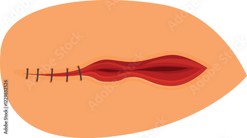 Surgical wound being closed with sutures, representing post operative care and healing