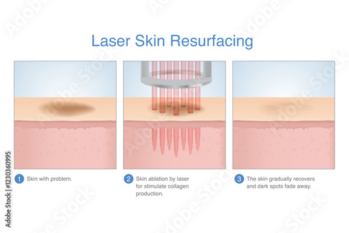 Laser skin resurfacing in 3 Step3. Skin with dark spots, freckles and scar on surface faded after treating with laser energy deep in the skin layer.