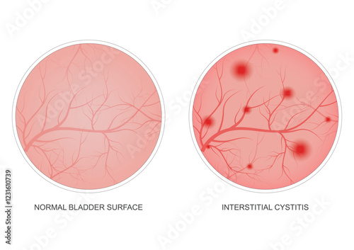 Normal skin surface and interstitial cystitis skin surface. photo