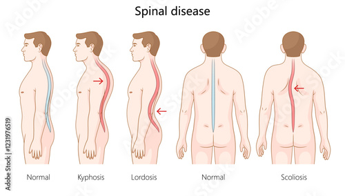 normal spine alignment with spinal disorders, including kyphosis, lordosis, and scoliosis, showing abnormal curves and posture diagram hand drawn vector. Medical science educational illustration
