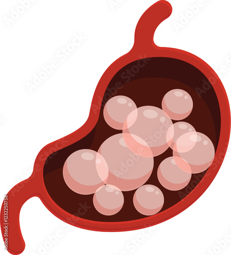 Bloating stomach showing abdominal distension caused by excessive gas in digestive system, medical illustration