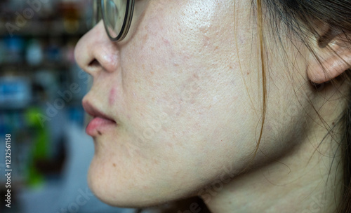 Cropped shot view of woman face with freckles and enlarged pores problem on her skin. A pore is small opening in a surface that lets stuff through. photo