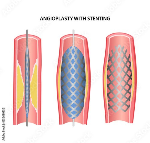 Angioplasty with stenting. Medical illustration of angioplasty of blood vessels. Vector illustration in flat style.