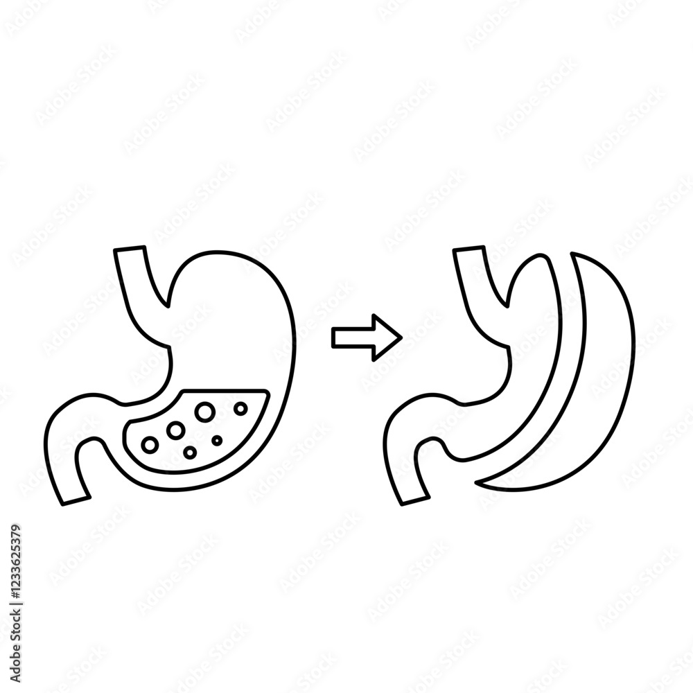 Fototapeta premium Gastrectomy