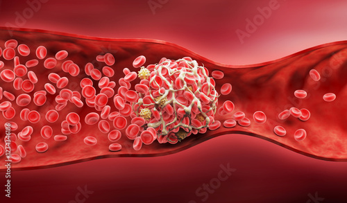 3D illustration of a blood clot, Thickened Arteries and Veins, Red Blood Cells, 3d illustration.