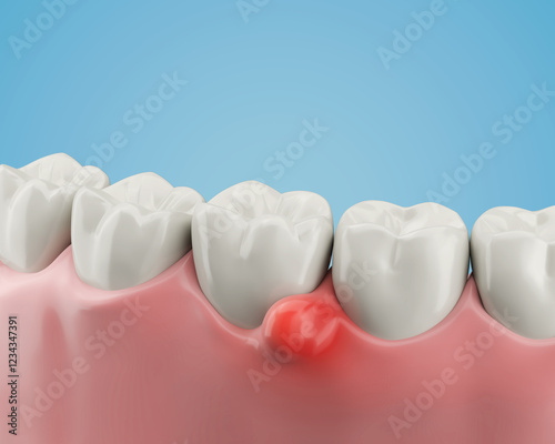 Quadro su tela 3d illustration of Swollen gums, Teeth with gum inflammation or Gum disease