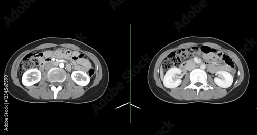 CT whole abdomen normal study: No abnormalities detected. All organs appear within normal limits with no signs of pathology.