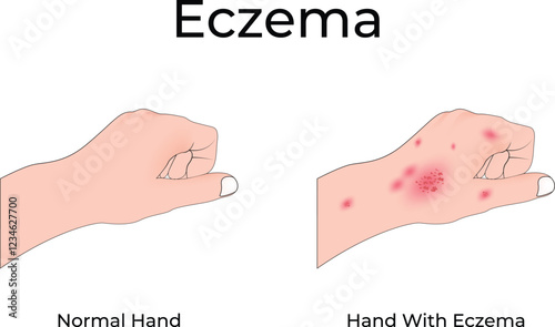 Eczema on Hand Design Vector Illustration