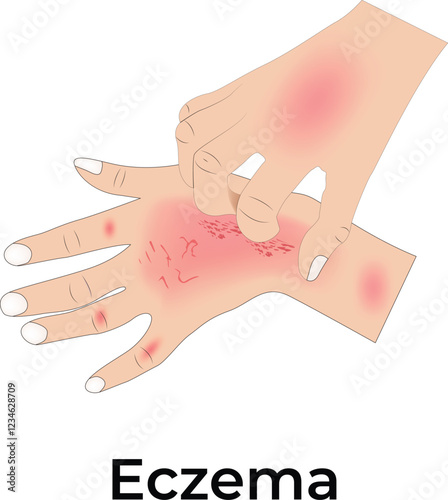 Eczema on Hand Design Vector Illustration