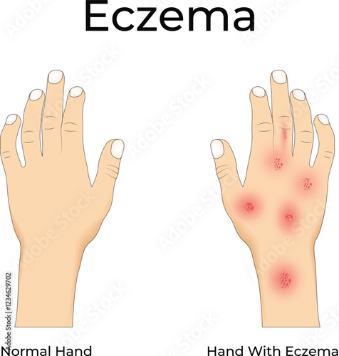 Eczema on Hand Design Vector Illustration