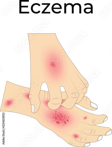 Eczema on Hand Design Vector Illustration