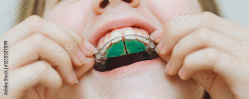 Dental plate. Expansion of the jaw in a child. There is not enough space for molars. Happy girl holding an orthodontic plate in her hands