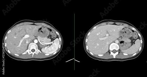 Contrast-enhanced CT whole abdomen study revealing normal anatomical structures, with no signs of pathology or abnormal fluid accumulation. photo