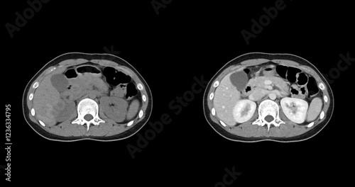 Contrast-enhanced CT whole abdomen study revealing normal anatomical structures, with no signs of pathology or abnormal fluid accumulation.