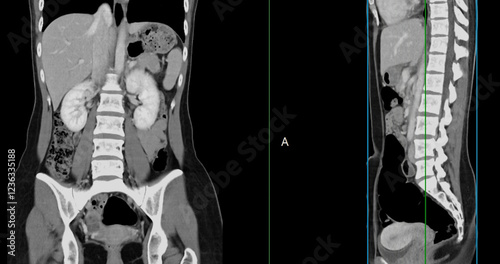 Contrast-enhanced CT whole abdomen study revealing normal anatomical structures, with no signs of pathology or abnormal fluid accumulation. photo