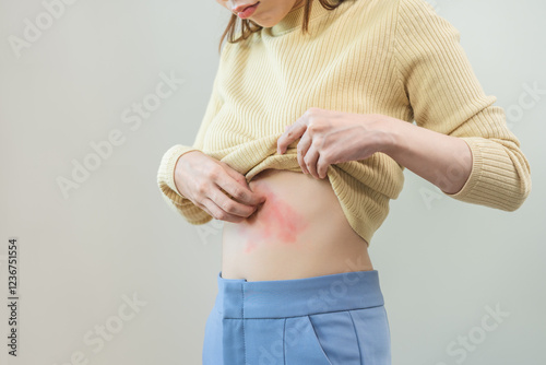 Dermatology injury asian young woman allergy, allergic reaction from atopic, insect bites or shingles on stomach, girl scratching itchy, itch red spot or rash of skin. Healthcare, treatment of beauty.