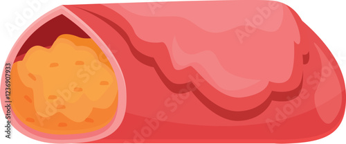 Cholesterol forms plaque in the artery, causing it to narrow and reduce blood flow, leading to health problems