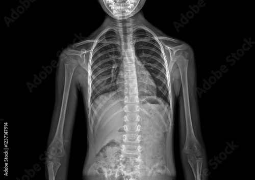 X-ray snapshot of childhood scoliosis