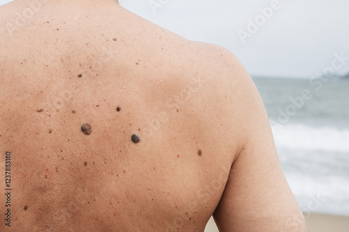 Wallpaper Mural The back of an elderly man with freckles, aging spots, black, brown warts and wrinkles against the background of the sea Torontodigital.ca