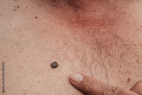 keratinizing squamous cell carcinoma of the skin of an elderly man photo