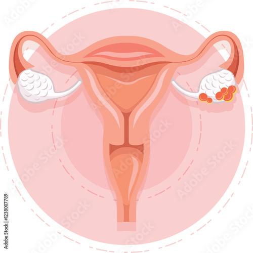 Ovarian Cancer Awareness, Detailed Vector Illustration Depicting Tumor Growth and Cellular Pathogenesis