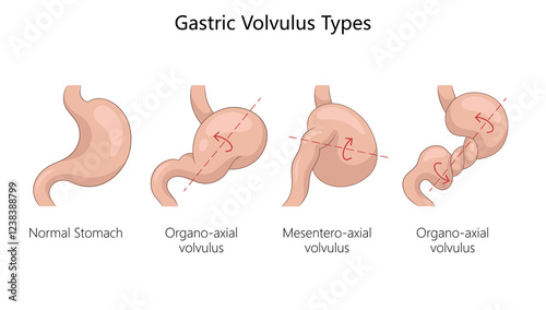 Fotografie gastric volvulus types, normal stomach, organo-axial volvulus, mesentero-axial volvulus with rotational axes diagram hand drawn schematic raster illustration