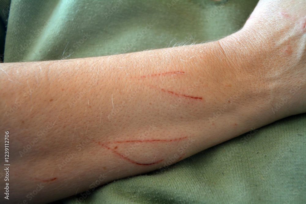 An arm with several bloody cat scratches on the skin An arm with several bloody cat scratches on the skin