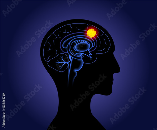 Brain cancer poster