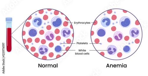 Vector illustration of the difference of number of healthy red blood cells. Anemia and normal.	