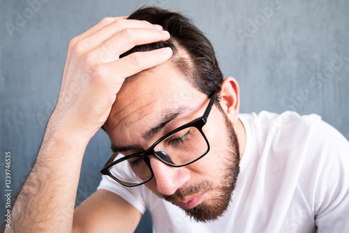 Hombre joven con alopecia. Hombre preocupado por la caída de su cabello 