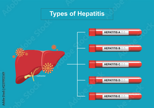 Types of hepatitis. Hepatitis is an inflammation of the liver.