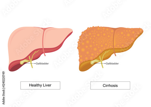 Cirrhosis of the liver is permanent scarring that damages liver.