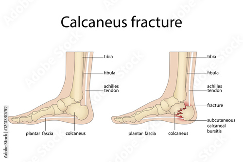 Anatomy of a calcaneal fracture with a diagram of the structure of a broken calcaneus