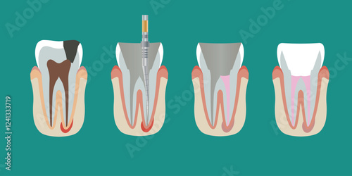 Tooth root canal treatment process