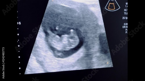 2D Ultrasound display of 10 weeks pregnant. Fetus ultrasound image that show important organs.