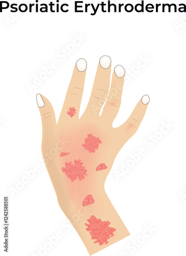 Psoriatic Erythroderma Design Vector Illustration