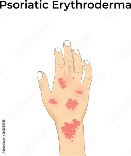 Psoriatic Erythroderma Design Vector Illustration