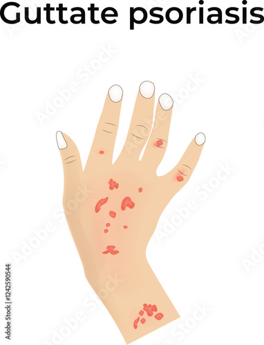 Guttate Psoriasis on Hand Design Vector Illustration